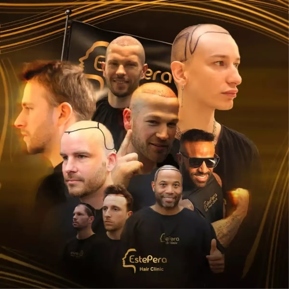 hair transplant in turkey why estepera leads the way in dhi sapphire fue and fue techniques 3t37Bq5u.jpg